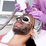 Carbon Laser Facial – 1 session