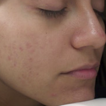 VI Peel Acne treatment