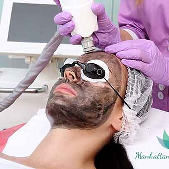 Carbon Laser Facial – 3 sessions